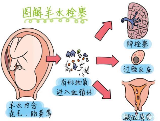 宫颈裂伤|贝安健康：羊水栓塞是什么原因引起的？