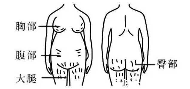 孕妇|什么时候开始预防妊娠纹?八成以上的孕妇都做错了!后悔就晚了!