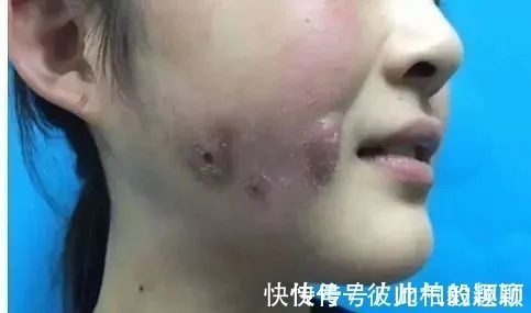 嘴角 这5个医美项目虽然很火，但很多医生不建议做！丨科普篇