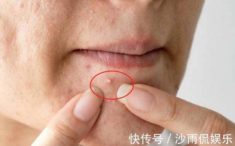 内分泌失调|女性有妇科炎症,脸上或许有4种表现,你若都不占,子宫很健康