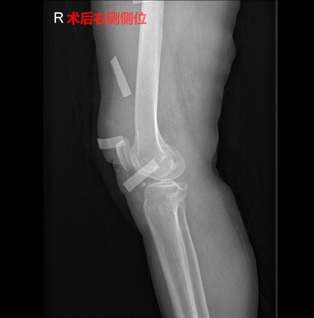 老太太|60岁老太太右膝痛了20年，一直治标不治本，结果查出这些问题