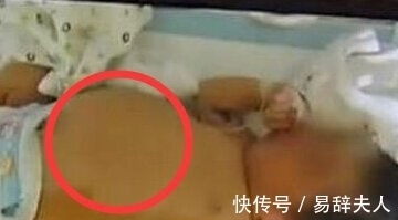 医生|【奇闻】孕妇产下“胎中胎”:刚出生8天女婴竟怀孕?