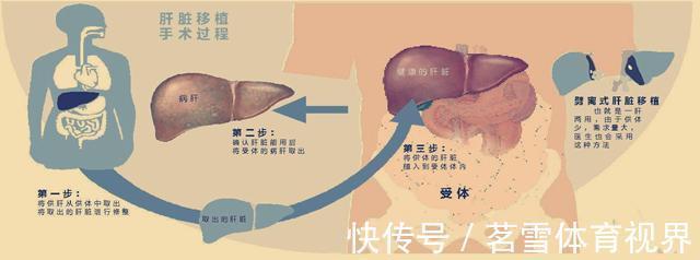 肿瘤|22岁妹子罹患肝癌,医生建议肝移植,妹子思考良久:不做