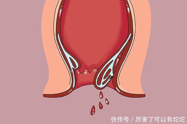  小事|长期腰痛不是小事，也许是癌症临门，尤其是伴随3个异常，需重视