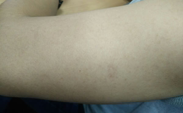 脱裤子时,为何会从腿上掉下来很多皮屑?是缺了什么营养素?