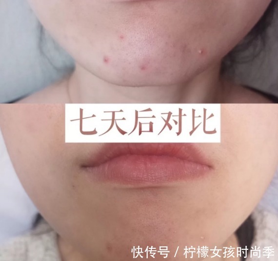 列入|3款被列入"黑名单"的祛痘印产品,看你有没有,花钱不少还没效果