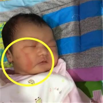 消退|孩子脸部“产钳印”没消退,婆婆怨儿媳没本事顺,网友好心凉