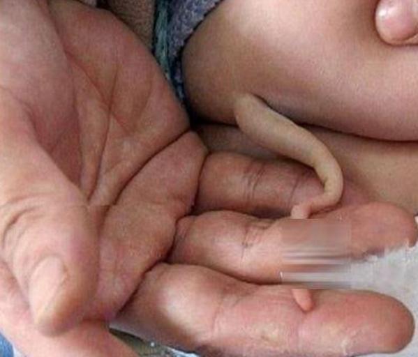 丈夫|三个月孩子长尾巴,家人带孩子去医院,医生检查后,母亲提出离婚