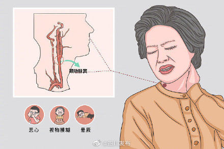 衣领综合征 穿高领、系围巾不舒服，可能是衣领综合征