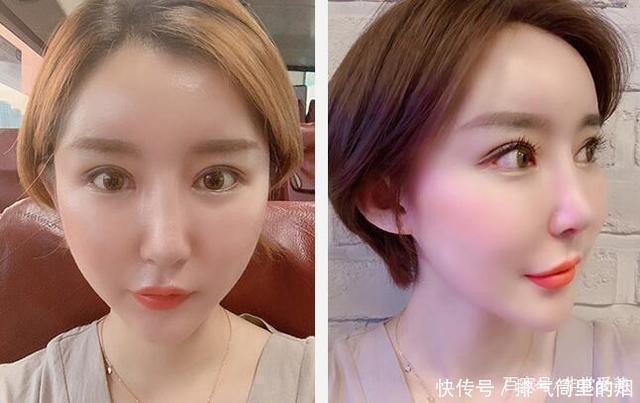 韩国妹子做眼鼻和脂肪填充,网友看到恢复照说侧颜秒杀金泰熙!