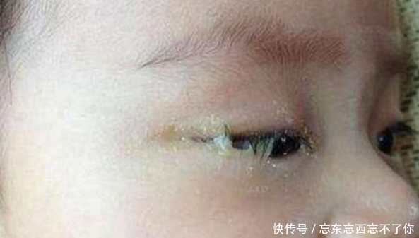 眼睛|婴儿眼睛迟迟睁不开,医生告知家长原因后,父母追悔莫及