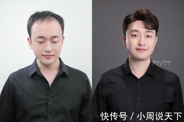 发型 地中海发型和戴假发,你更不能接受哪个!