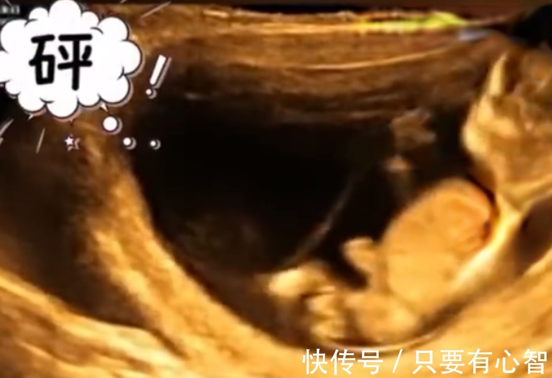 四维彩超|孕妈做四维彩超时突然腹痛,B超显示让人忍俊不禁,网友:挺无辜