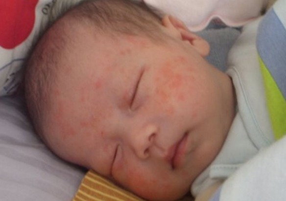 荨麻疹|在冬季给孩子打疫苗时,父母要注意3个问题,别让孩子发生意外