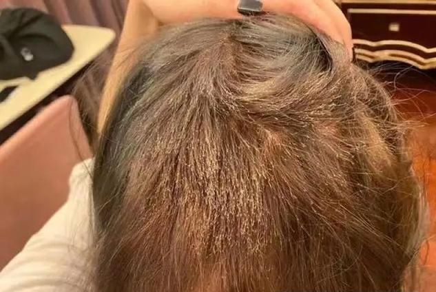 头发|“赔偿我20万元钱!”女生花1000元染发后,变“狗啃式”出不了门