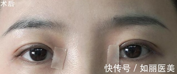 经验 做过全切双眼皮手术的"过来人",分享10条最实用的经验