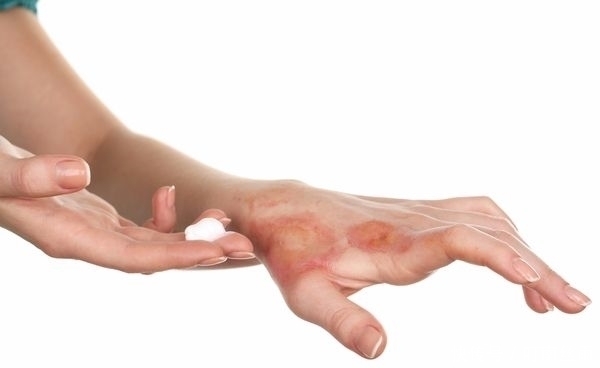 烫伤后,抹牙膏管用吗?水疱能不能戳破?这些生活小常识了解一下