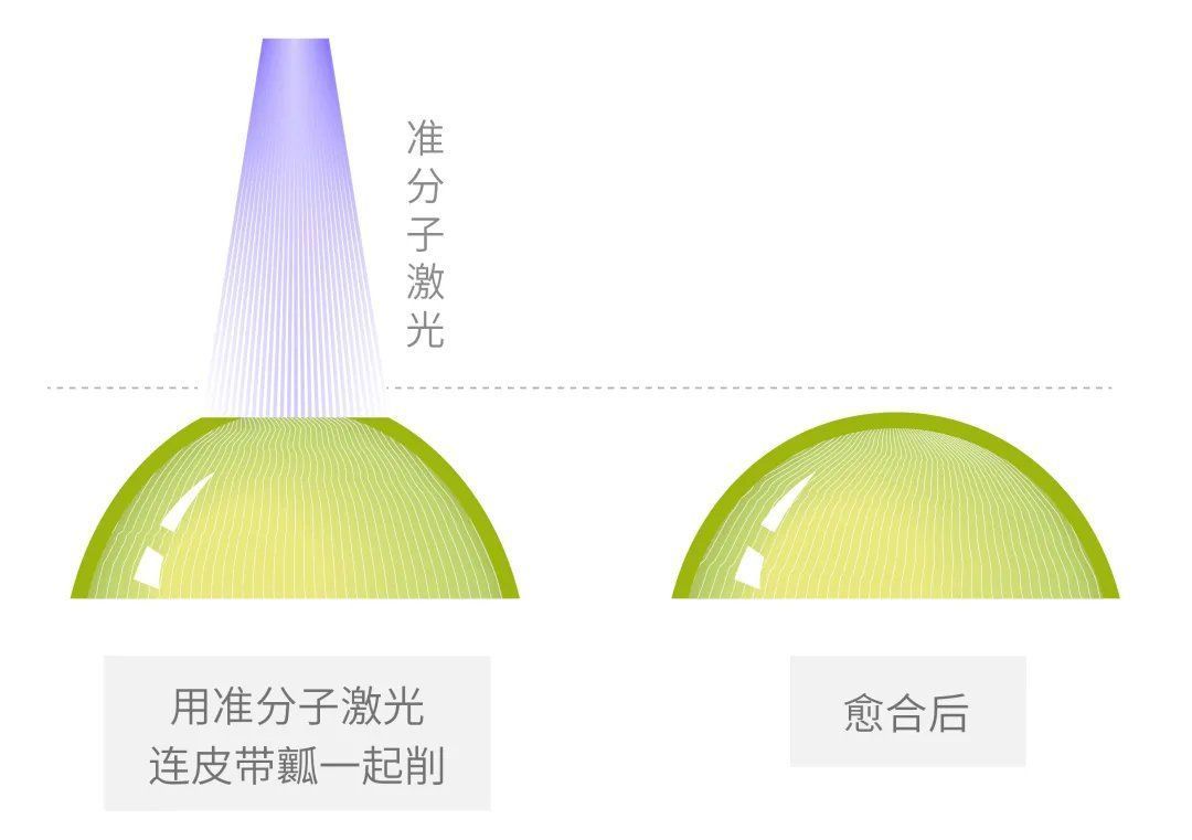 角膜|近视手术该不该做?怎么选?一文给你讲清楚