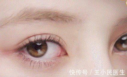 眼膜 王小民教授:为什么眼周很容易出现皱纹?