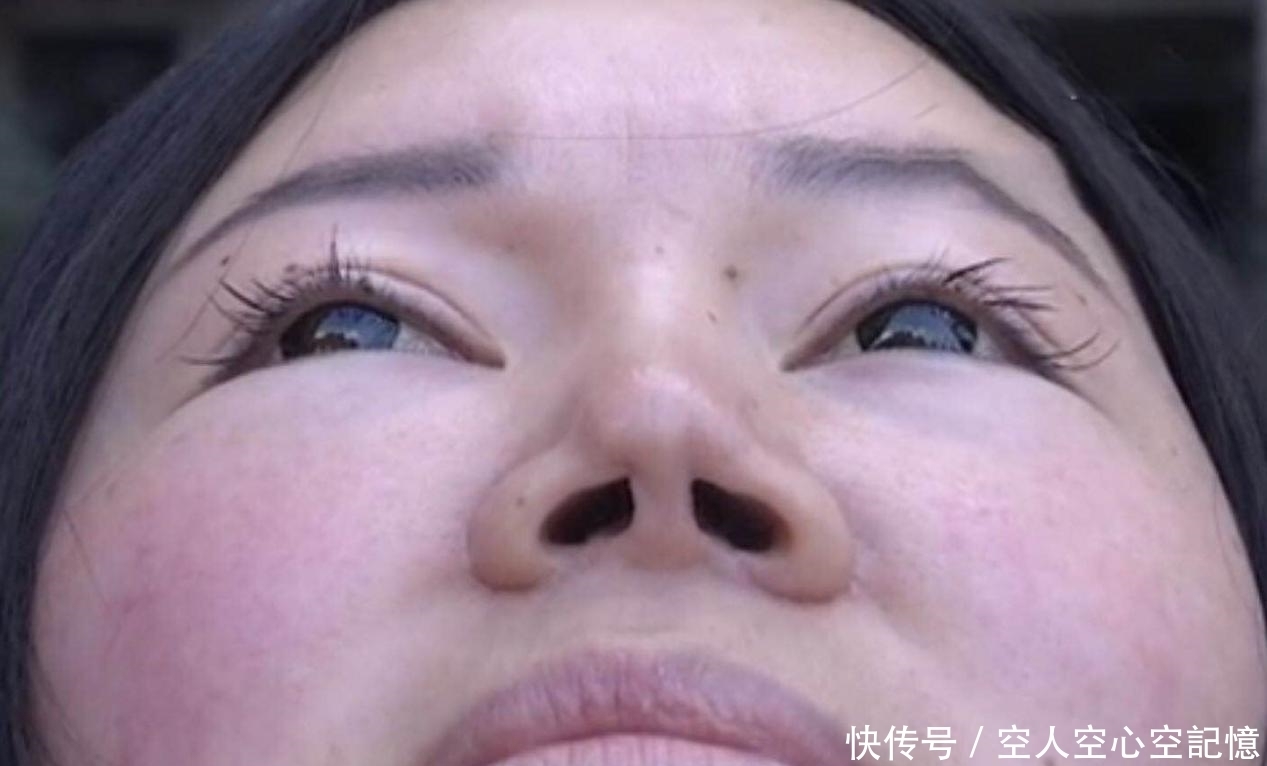 整鼻失败后,呼吸变得困难,工作人员表示:我新来的