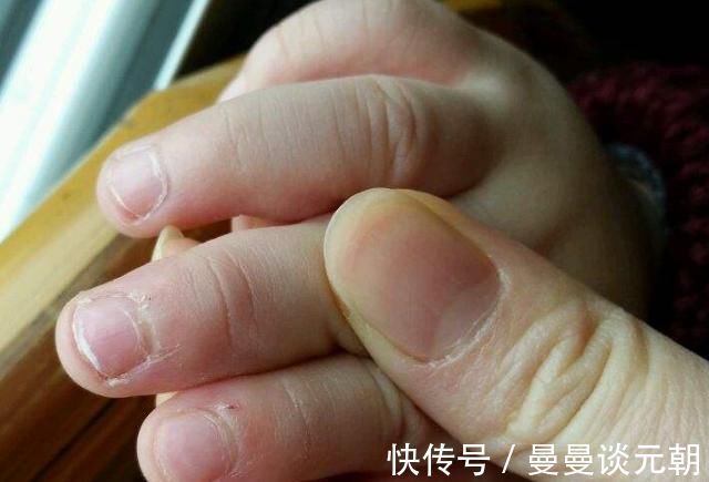 手指|手上长倒刺可以撕掉吗最好不要这样去做，小心手指肿成胡萝卜
