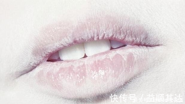 胃病|不想“胃炎”变“胃癌”3大胃病“克星”,养护脾胃更健康