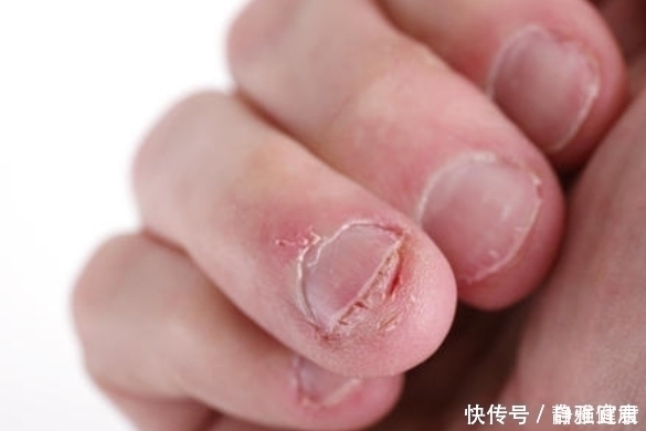 指甲癖|18岁了为什么还啃指甲?有什么办法可以不咬指甲?