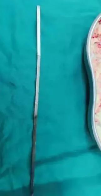 男子|怎么吞下去的？男子被20厘米烤肉簽穿肺…