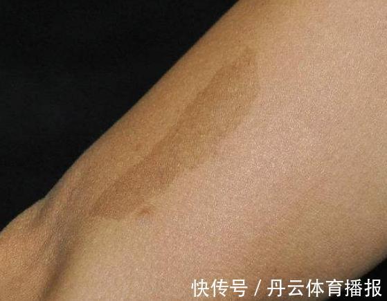 祸根|胎记长在哪里最有福气?恕我直言,2种胎记长哪都可能是祸根