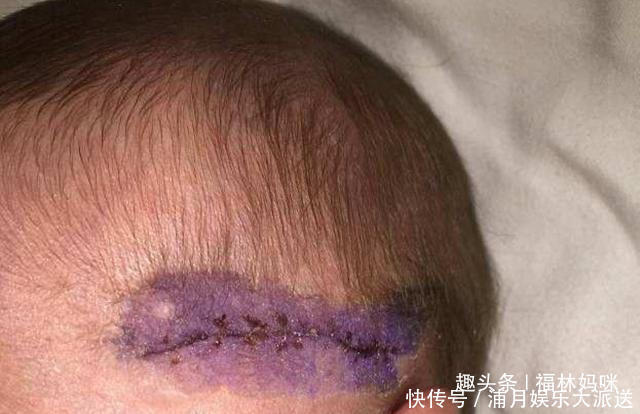 产妇|剖腹产会划伤孩子吗避免划伤宝宝，孕期和生产时要注意5点