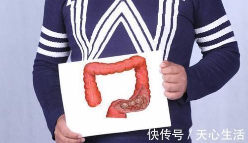 夫妻之间|医生实言相告三种癌症可能在夫妻间传染,为了爱人了解下