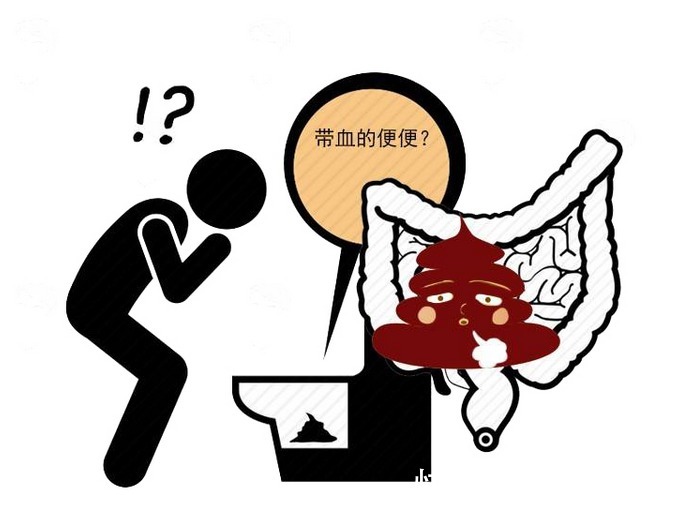 直肠癌|排便后不妨看看,出现便血,这样分析是痔疮还是直肠癌信号!