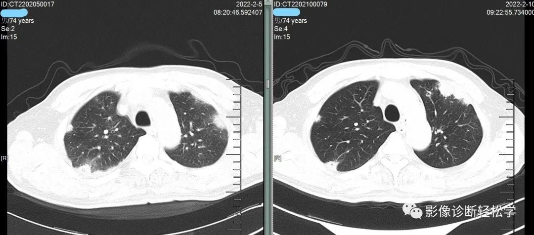 金葡菌|快快乐乐过大年，轻松学习肺部影像 实战篇 续