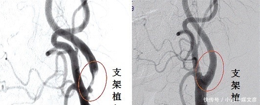 脖子上长了这个东西要当心！医生：多数脑梗都是因它而起！