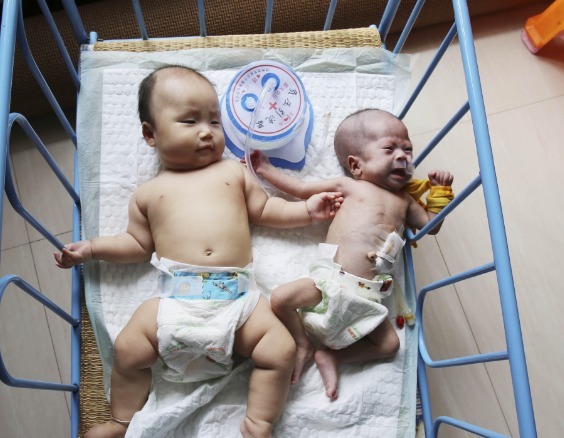 管子|妈妈生下双胞胎女儿,看到大女儿时妈妈发呆,只能用绳子绑住