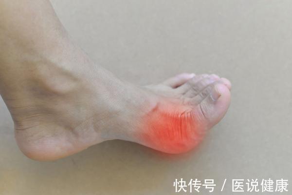 尿酸值|不想被痛风“缠上”了,这6个不良行为,尽量避免,或能防止痛风