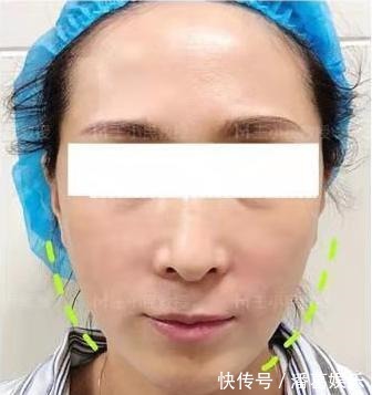 小拉皮 面部拉皮王小民教授:你要悄悄逆生长,然后惊艳所有人!