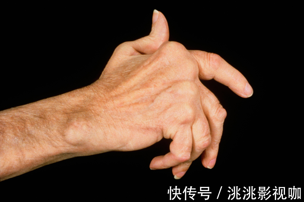 瘀血|“类风湿性关节炎”的中医治法！教你3招逼出湿气，别再被坑了！
