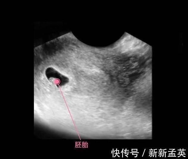 胚胎|胎儿从卵泡到性别形成,17张图片清晰诠释,男宝女宝看得很清楚