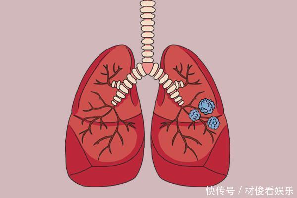 肺結節|體內有結節的人，碰到3種食物，寧愿倒掉也別吃，易助長結節