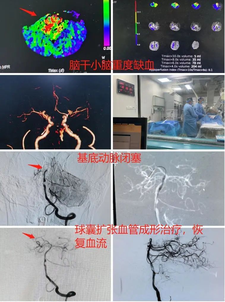 脑中风|晨起意识不清，脑中风； 急诊介入治疗，保性命