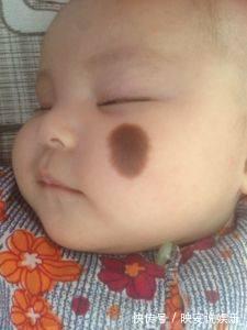 马虎|避免宝宝出生长胎记,怀孕期间一定要记住3件事,别马虎大意