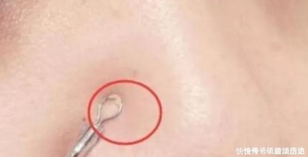 鼻子上挤出“白色条状物”?学会这3招,从此告别“草莓鼻”!