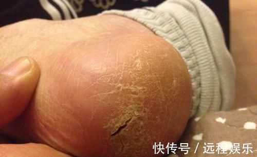 烦恼|橘皮泡脚,越泡越有!老人坚持用橘皮泡脚,10年的烦恼终于解决了