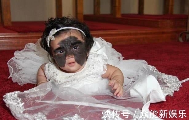 外科医生|真人版“蝙蝠侠”,美国一婴儿患罕见黑色素痣,形状酷似蝴蝶翅膀