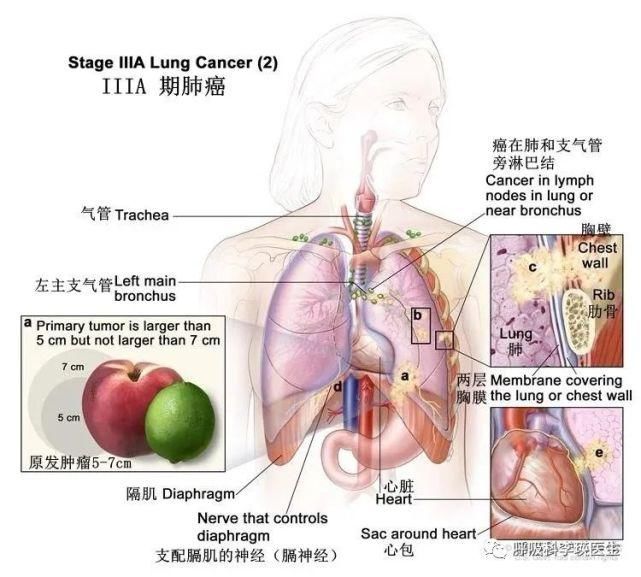 肿瘤|肺癌的治疗要花多少钱？晚期肺癌还有必要治疗吗？