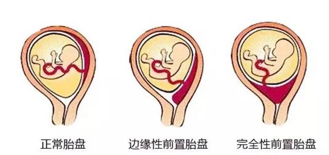 针对性|孕早中晚期的见红，分别是什么原因？准妈妈要懂得针对性处理