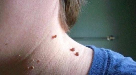 服用|“扁平疣”让女人抓狂的皮肤病，一味中药泡水喝，可以搞定