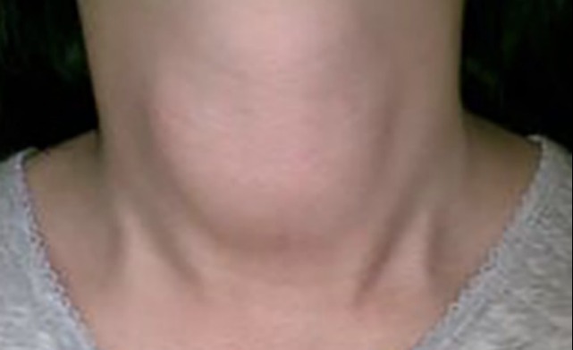 医生|44岁女子确诊甲状腺癌,医生:常吃这1“粗粮”,钢做的甲状腺也扛不住