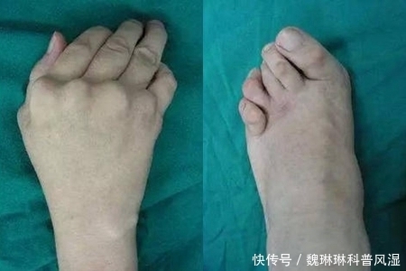 雪后天寒,类风湿患者为什么这么怕冷?又该如